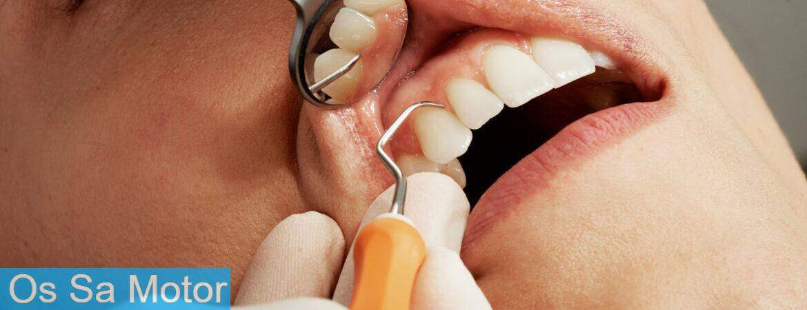 Beneficios de la periodoncia